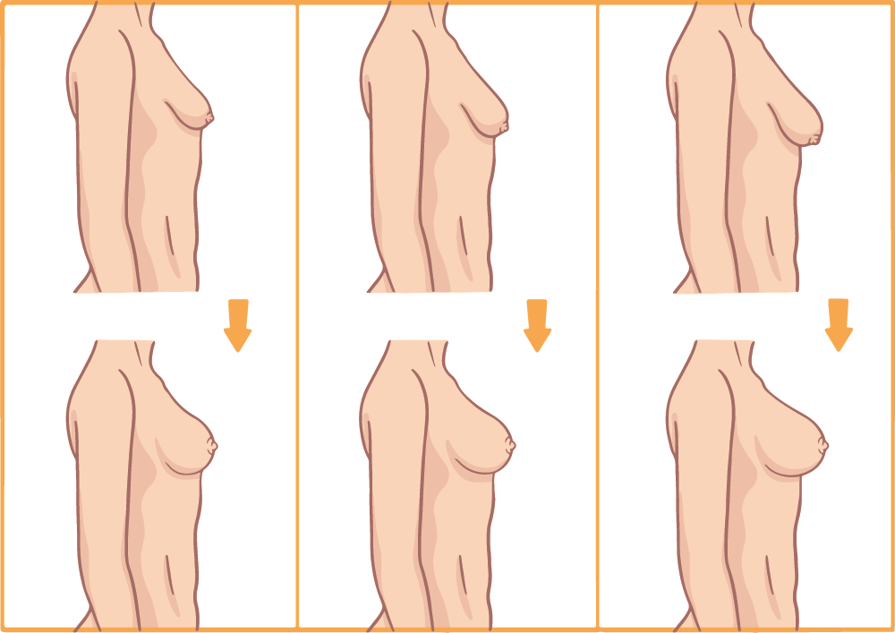 Bruststraffung Abbildung vorher nachher Vergleich in 3 Optionen