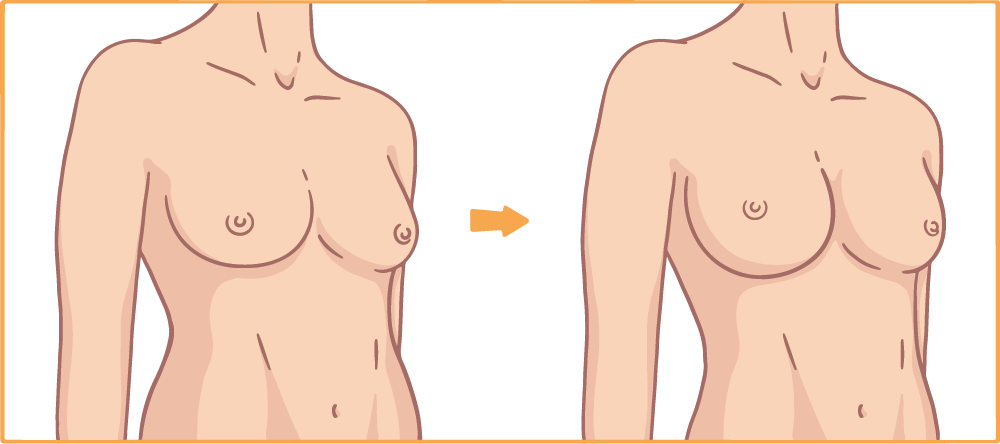 Brustvergrößerung Eigenfett Abbildung Anatomischer Form