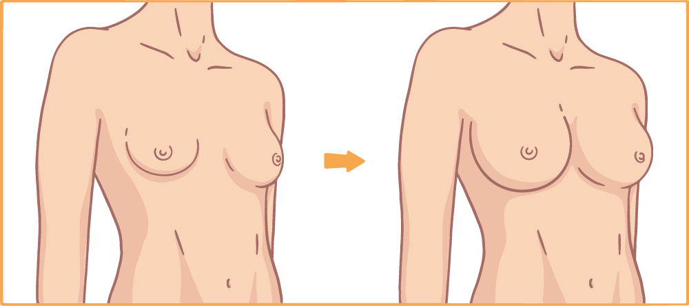 Brustvergrößerung mit Implantat Abbildung Vergleich vorher Nachher Runde Brüste