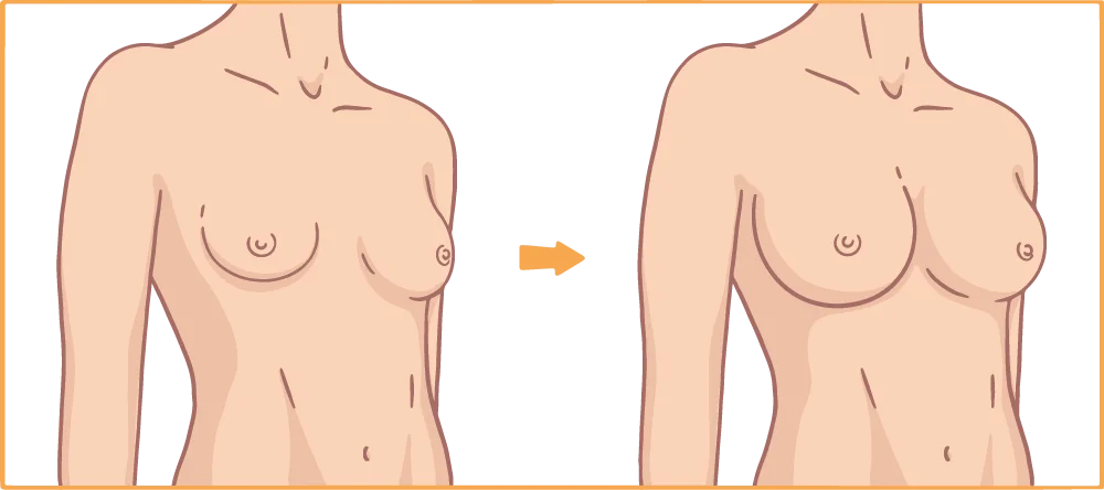 Brustvergrößerung mit Implantat Abbildung Vergleich vorher Nachher Runde Brüste
