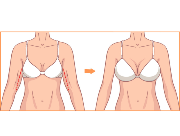Brustvergrösserung Mit Implantate Kombiniert Mit Fettabsaubung In Den Oberarmen