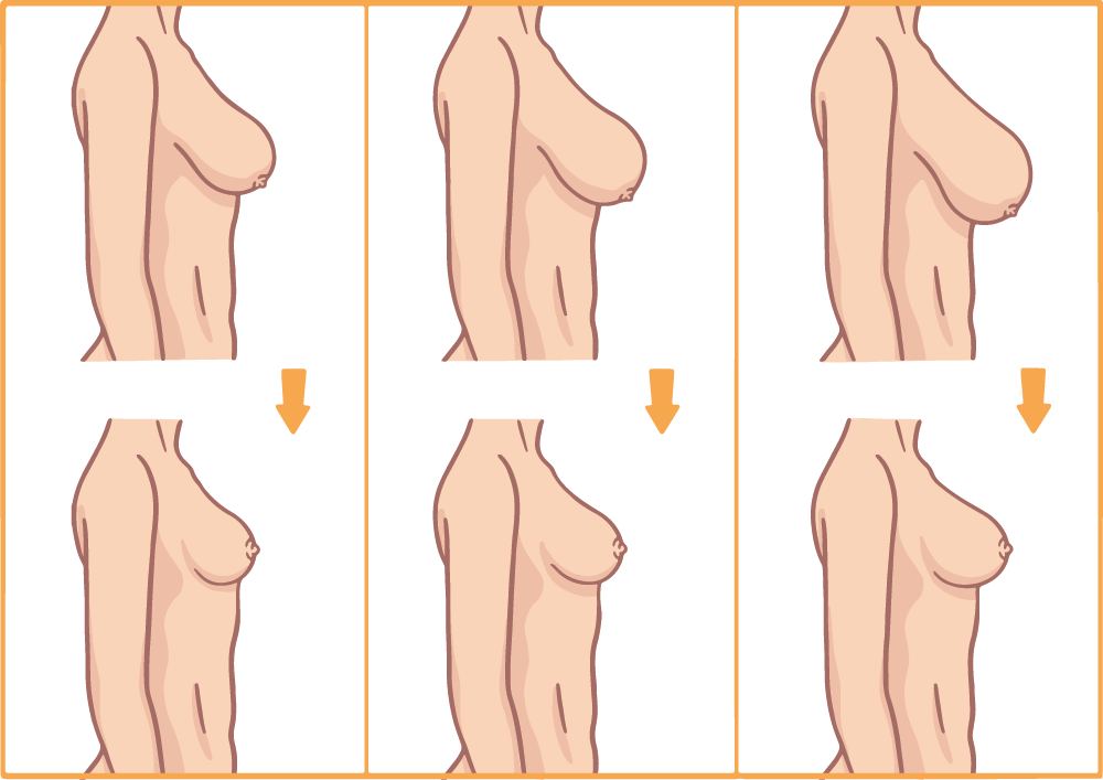 Brustverkleinerung Optionen verschiedene Körbchengrößen