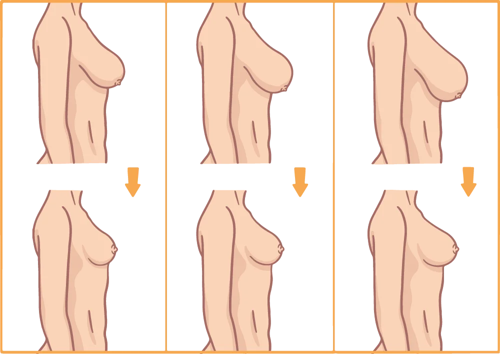 Brustverkleinerung Optionen verschiedene Körbchengrößen