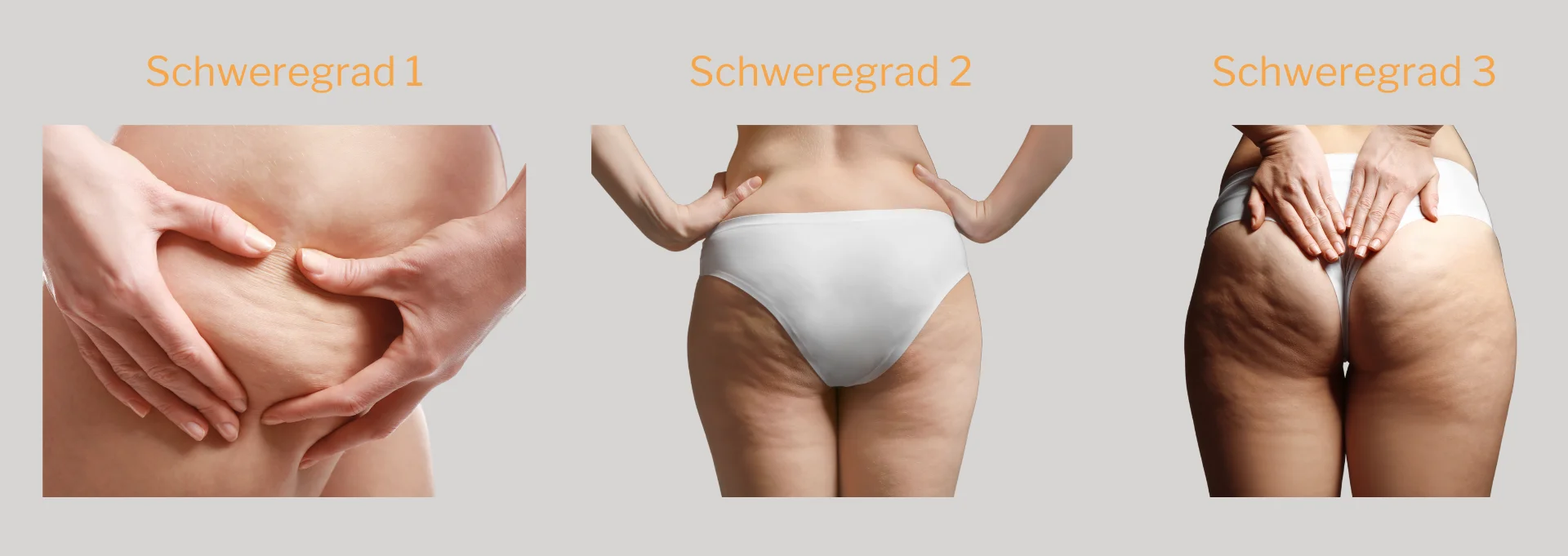 Schweregrade von Cellulite