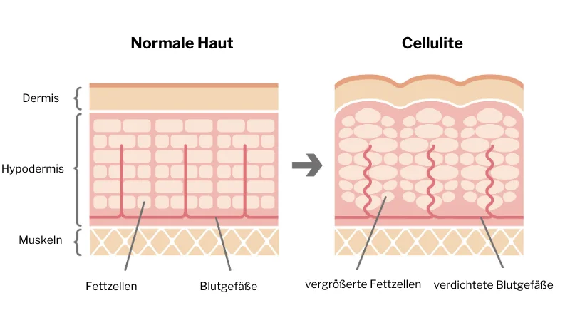 Normale-Haut-vs.-Cellulite